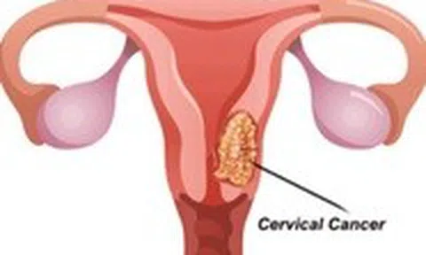Ung thư cổ tử cung giai đoạn 2 được điều trị bằng cách nào?